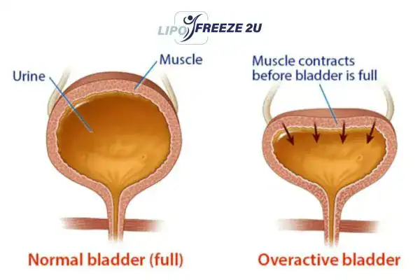 diagram of overactive bladder treatment Ely