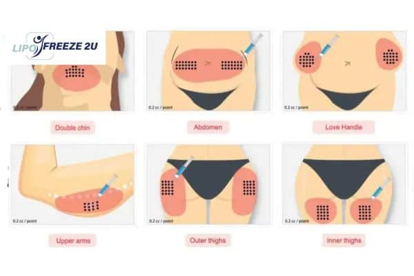 Benefits of Choosing Aqualyx for Fat Reduction Ely