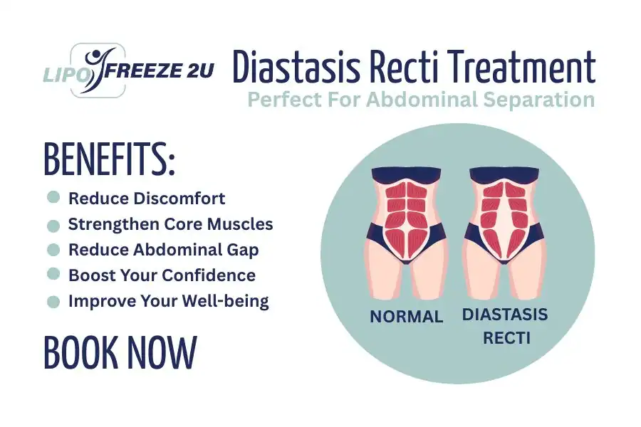How Long Will It Take to See Improvements in Diastasis Recti Ely