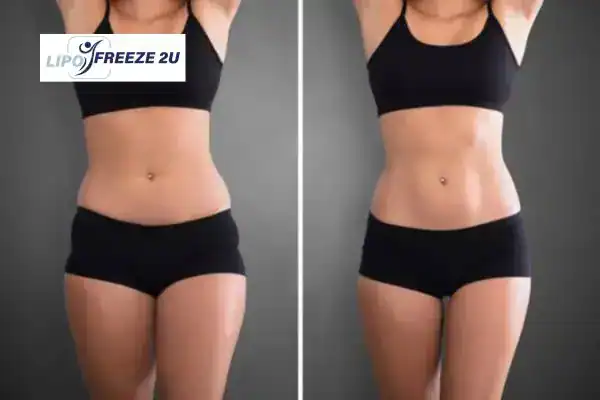 How Can LIPO FREEZE 2U Support Your Post-Pregnancy Body Recovery Ely?