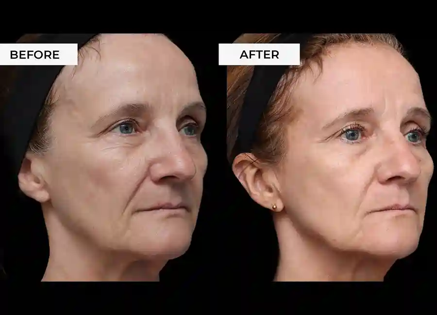 How Many RF Microneedling Sessions Will You Need to See a Difference Ely?