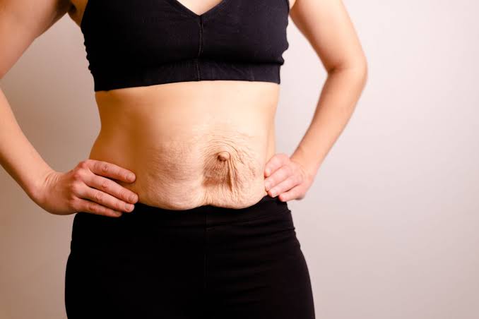 Is Surgery Really the Only Way to Repair Diastasis Recti Ely?