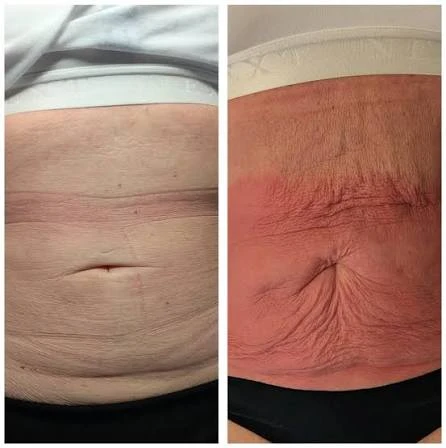 How Does RF Microneedling Improve Crepey, Thin and Uneven Skin Texture Ely?