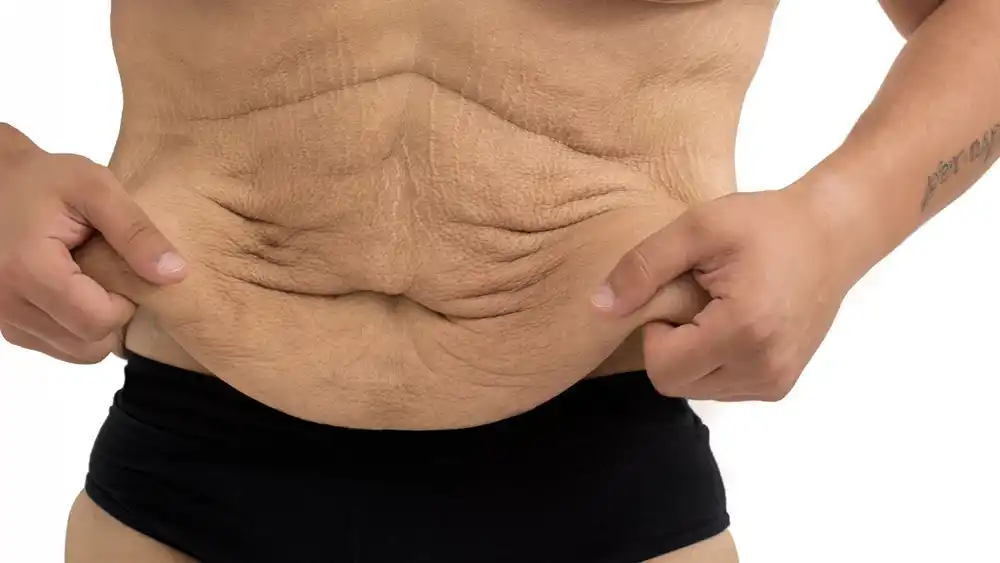 RF Microneedling for Loose Skin: How Can It Help Tighten and Reshape the Skin Ely?